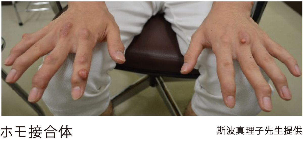家族性高コレステロール血症 Fh について 心筋梗塞 不安定狭心症で入院中の方とそのご家族へ再発予防ガイド
